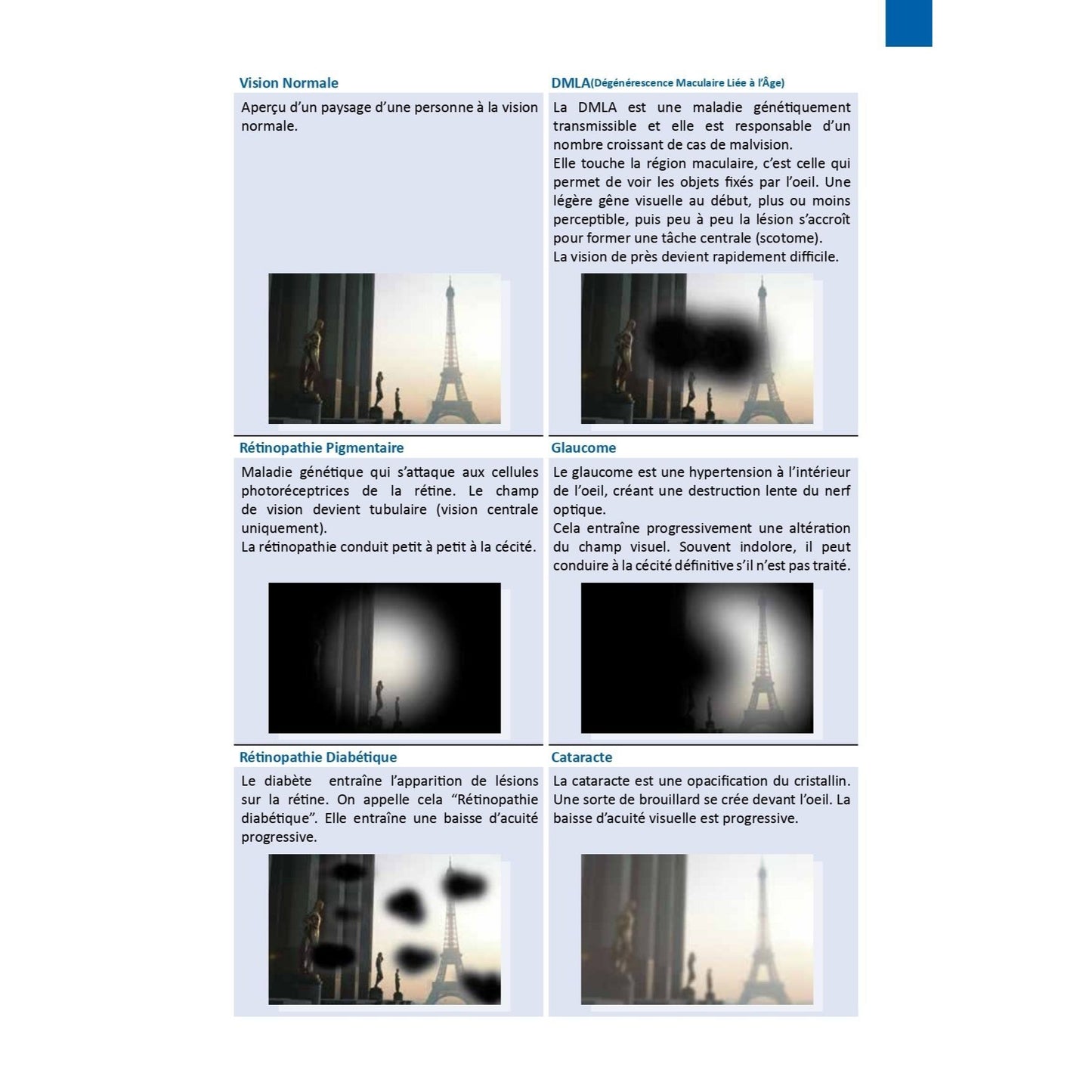 Flipper for Glaucoma and Pigmentary Retinopathy